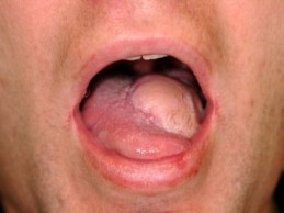 Patient with mouth open, displaying a tumor on the tongue