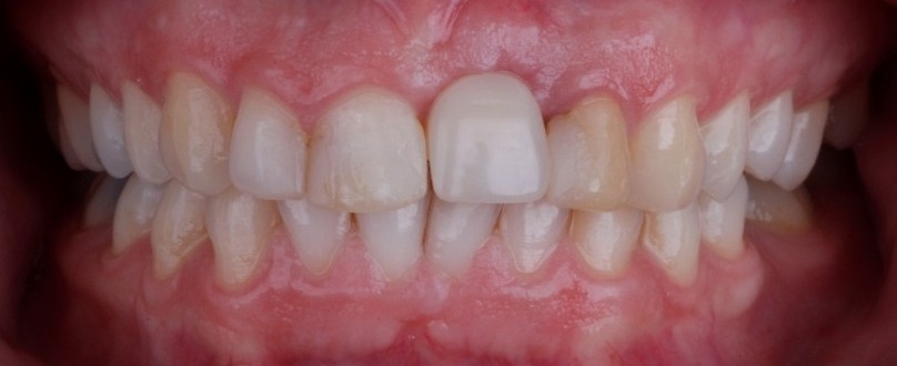 Whitening Before