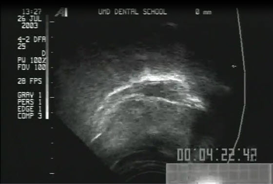 MRI of a person swallowing