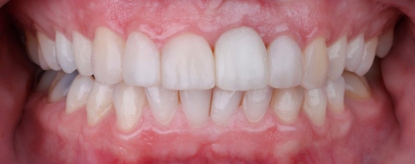 Whitening After