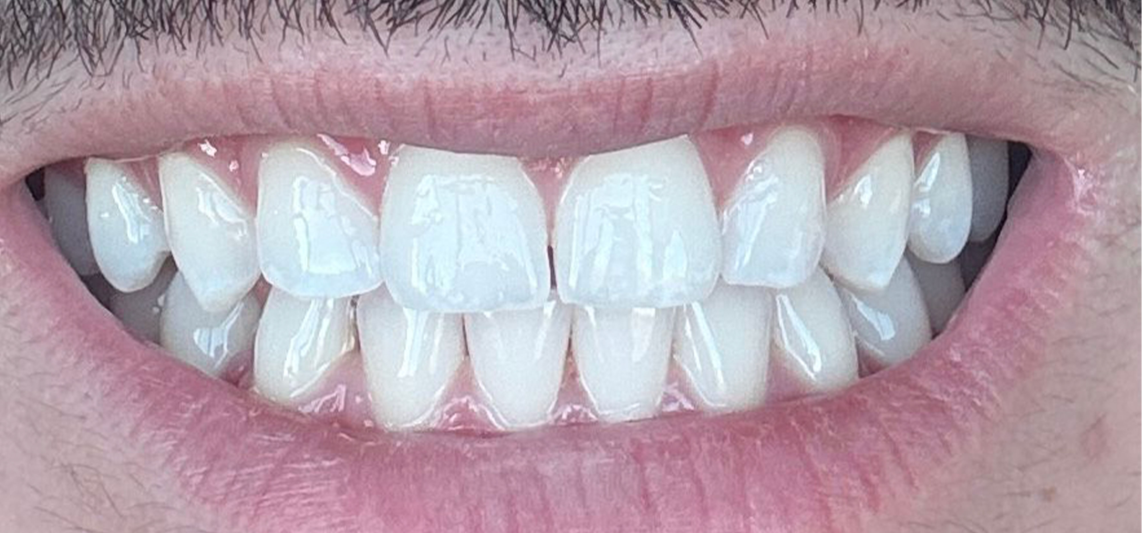 Teeth whitening after