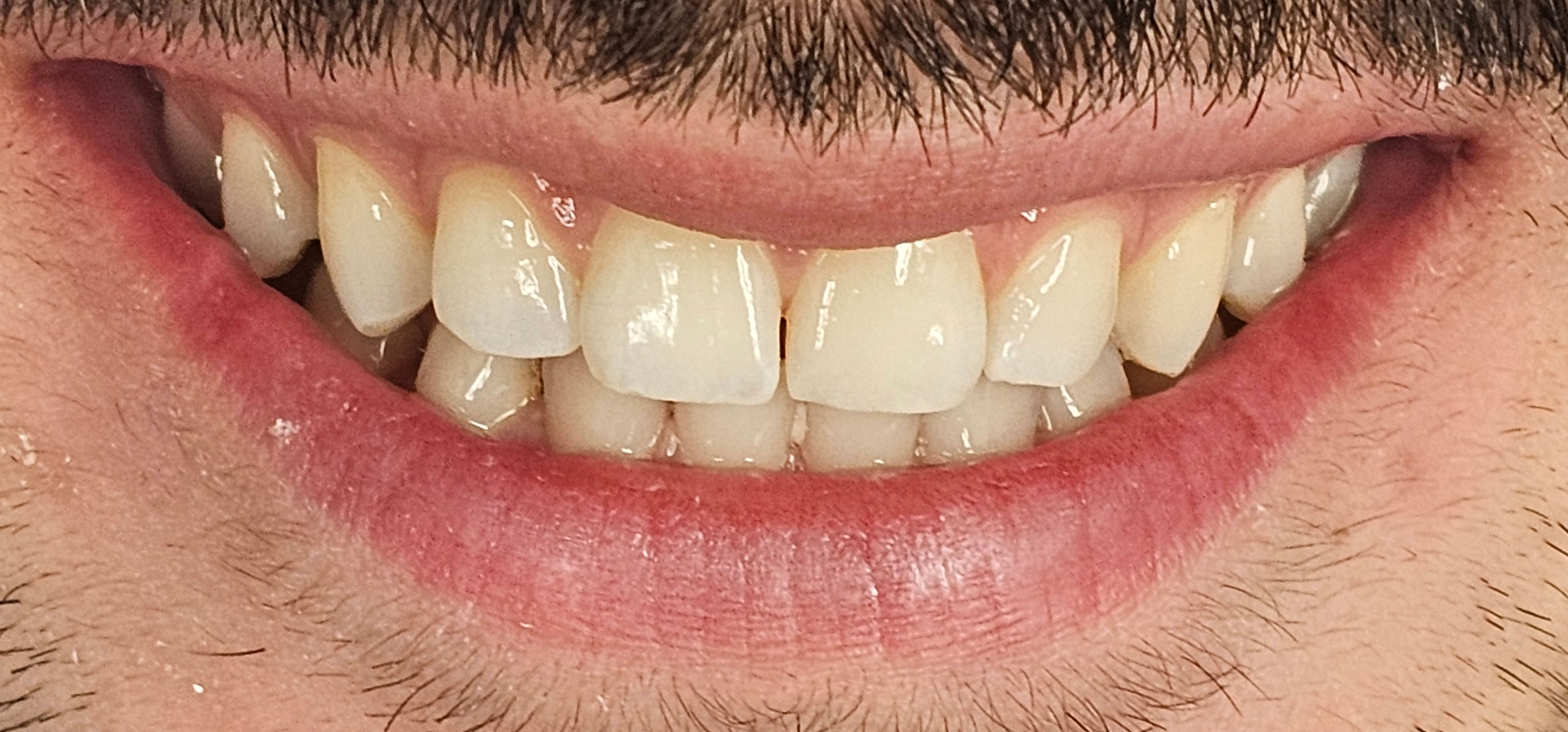 Teeth whitening before