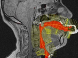 Profile view of MRI demonstrating speech